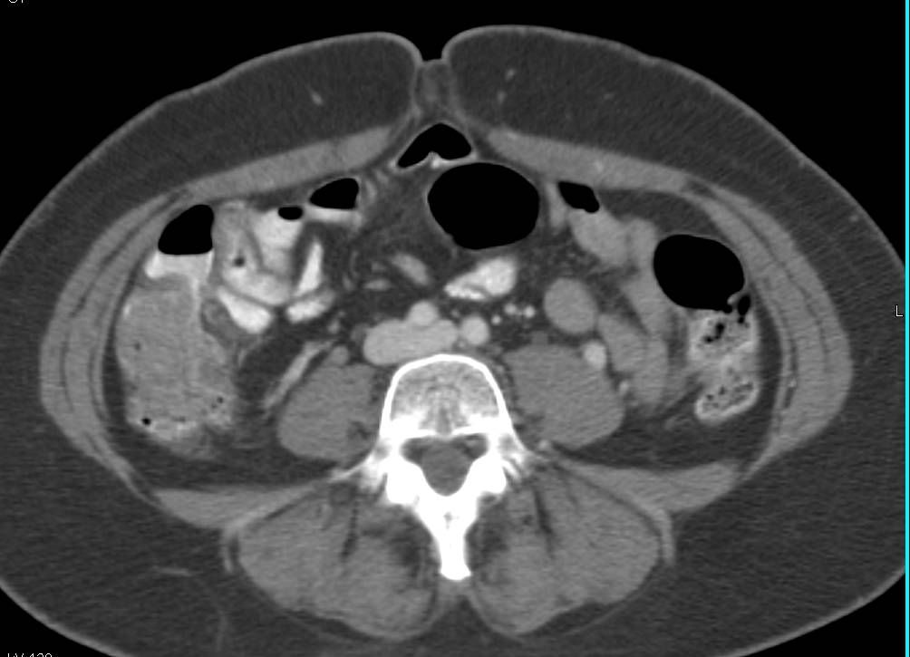 Cecal Carcinoma - CTisus CT Scan