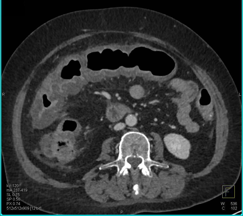 Pseudomembranous Colitis with Trace Ascites - CTisus CT Scan