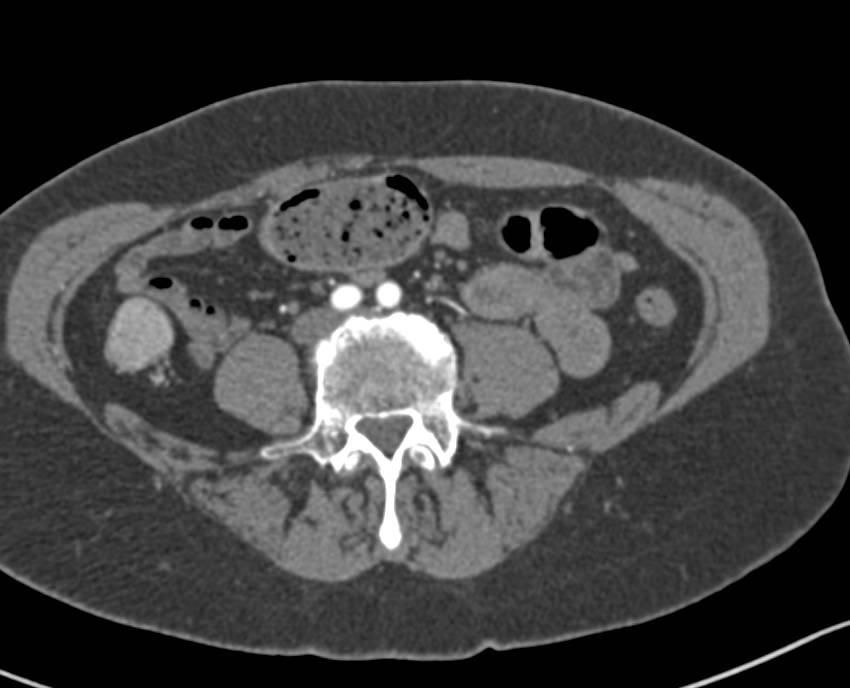 Colitis Right Colon - CTisus CT Scan