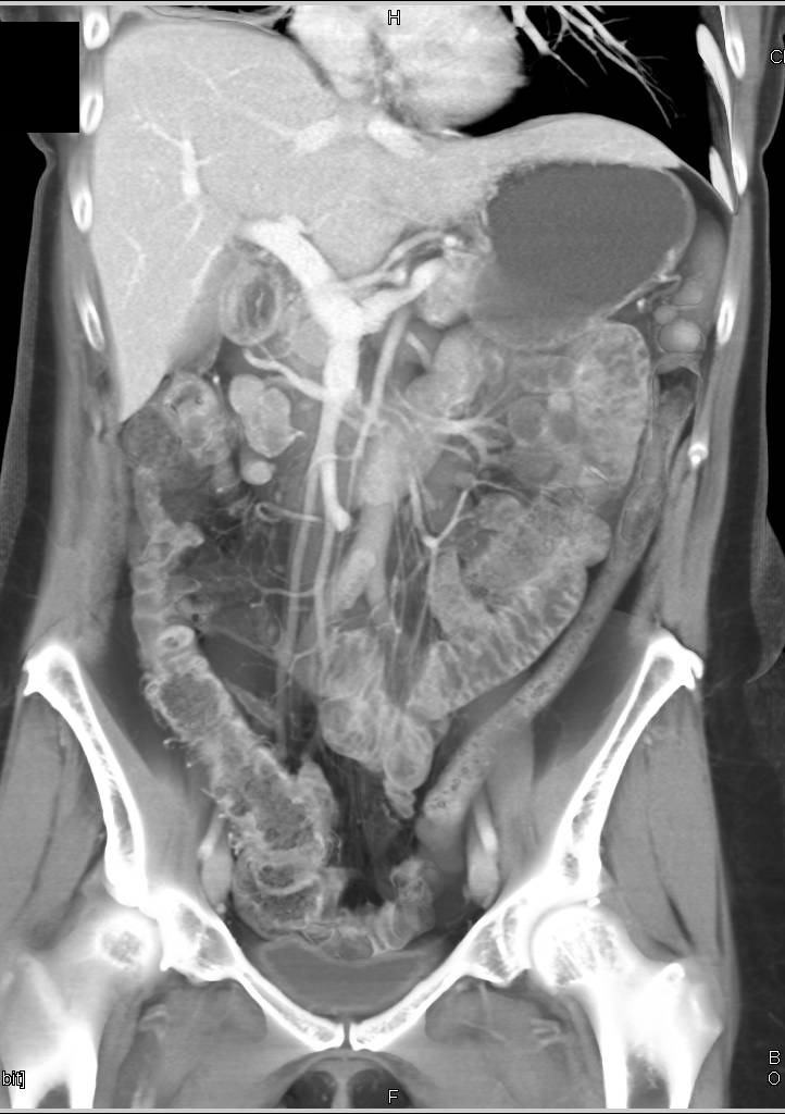 Colitis with Stricture Right Colon - CTisus CT Scan
