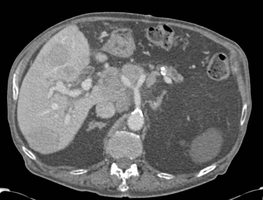 Peripancreatic Adenopathy and Liver Metastases from Colon Cancer - CTisus CT Scan