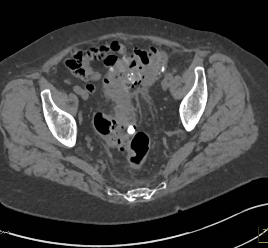 Diverticulitis with Involvement of the Bladder - CTisus CT Scan