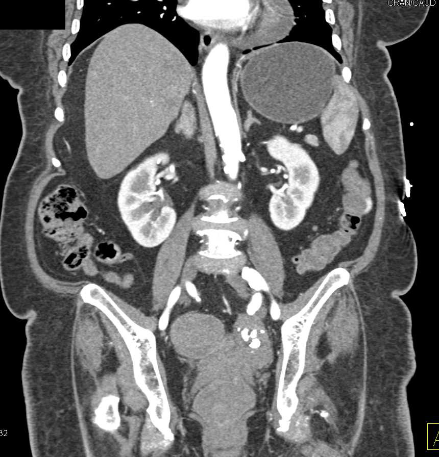 CTA with Active Bleeding Left Colon due to Bleeding Diverticulum - CTisus CT Scan