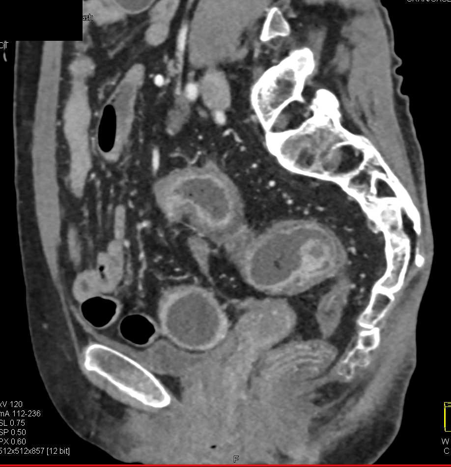 Ulcerative Colitis with Stricture Best Seen in Rectum with Inflammatory Polyps - CTisus CT Scan
