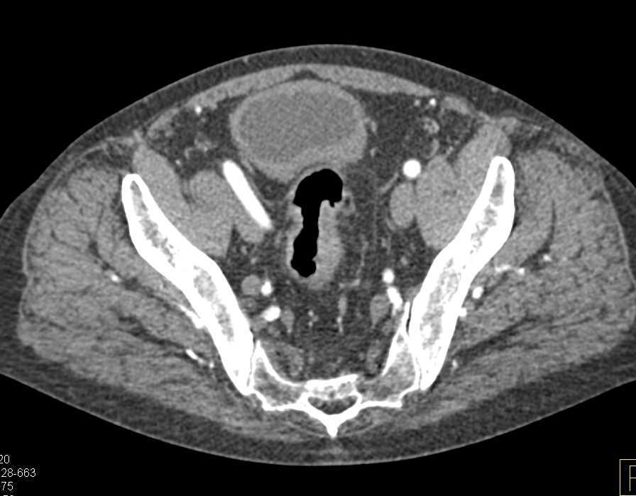 Carcinoma of the Rectum and Sigmoid Colon - CTisus CT Scan