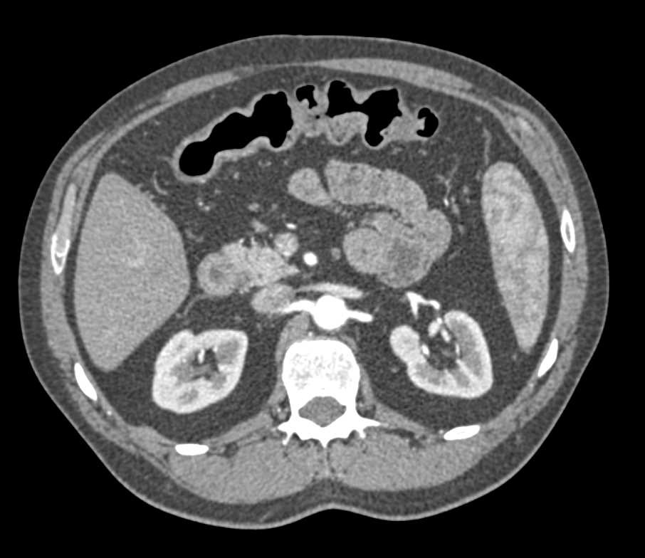 Crohn's Disease Colon and Terminal Ileum - CTisus CT Scan
