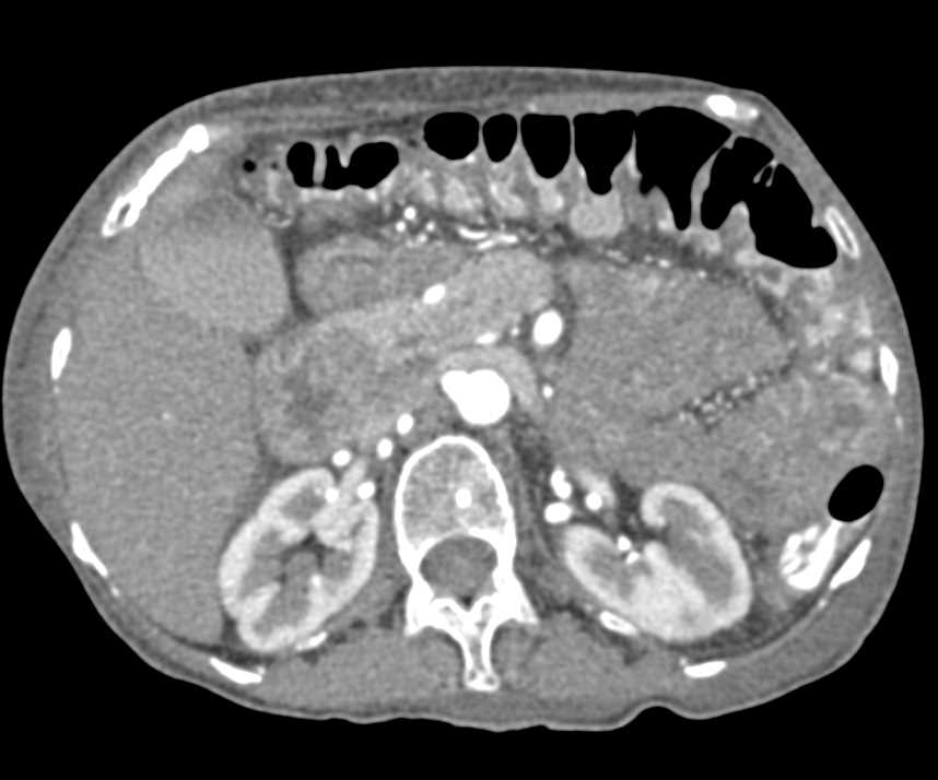 Colitis with Prominent Vasa Recta - CTisus CT Scan