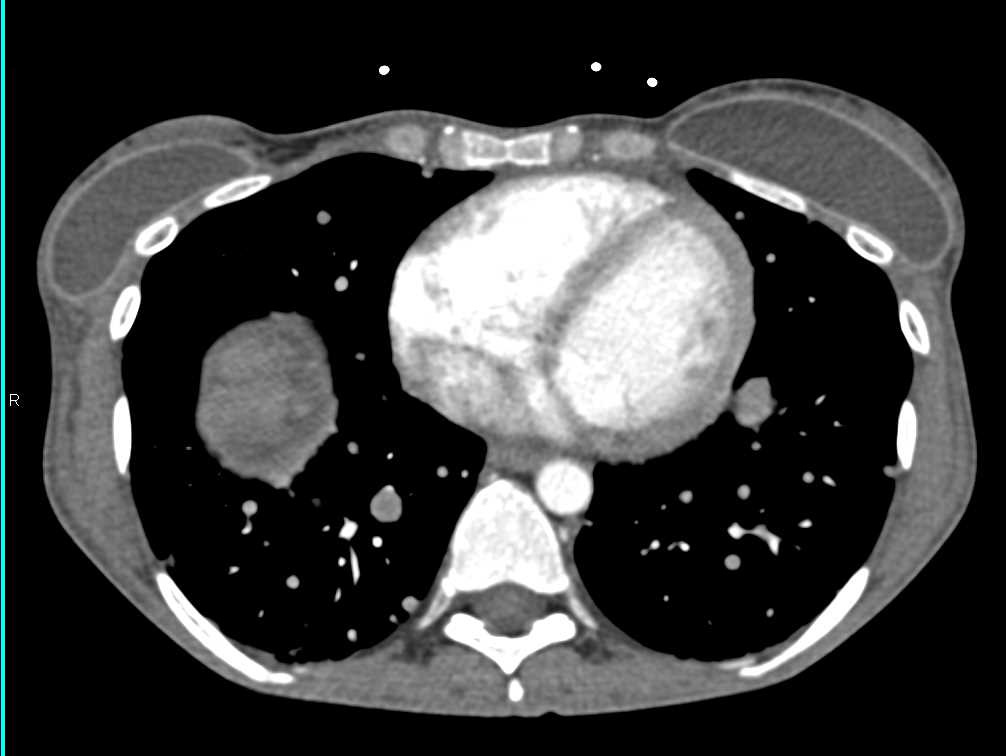 Metastatic Colon Cancer with Liver Metastases and Carcinomatosis - CTisus CT Scan