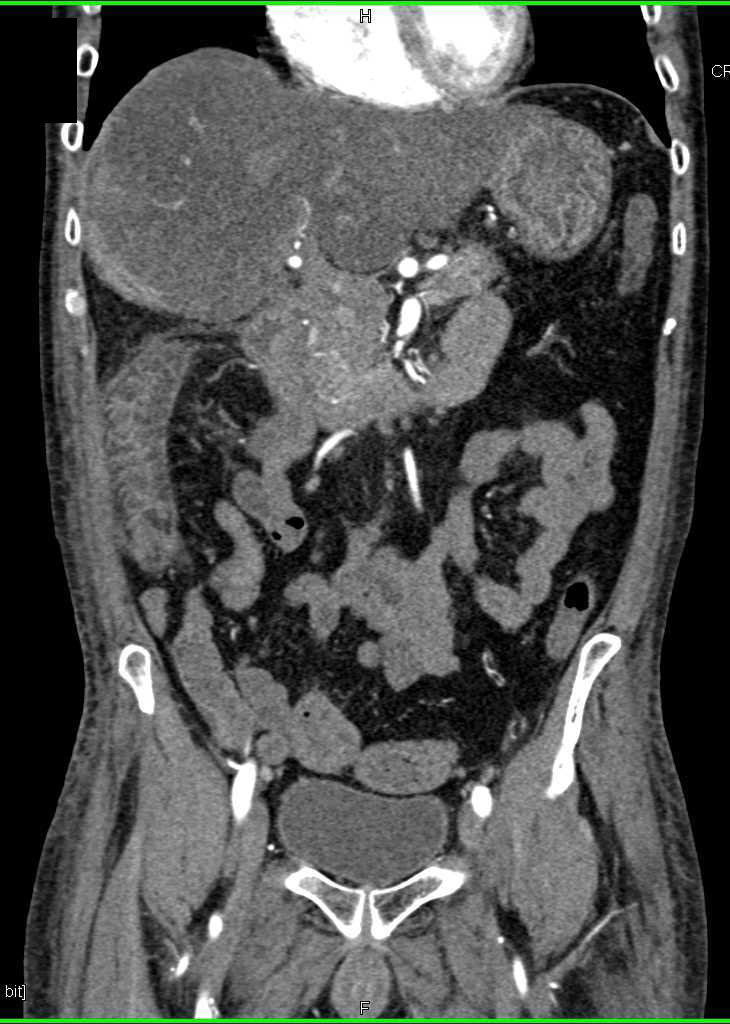 Crohn's Disease and Fatty Liver - CTisus CT Scan