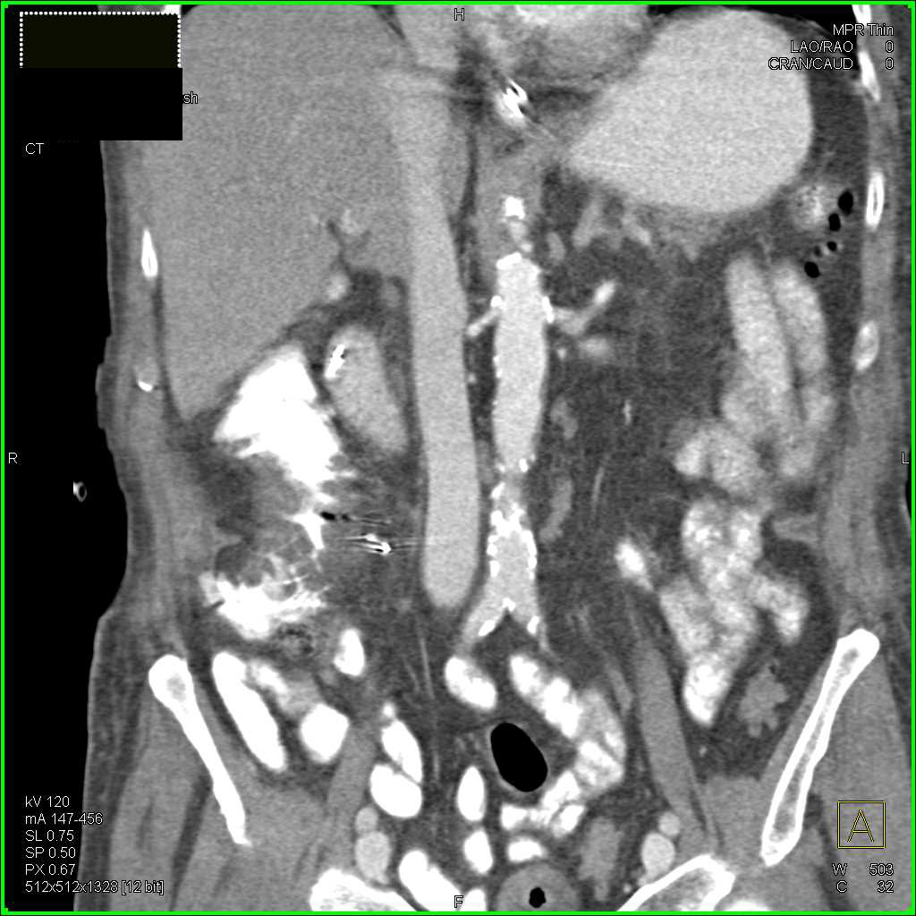 Right Sided Diverticulitis - CTisus CT Scan