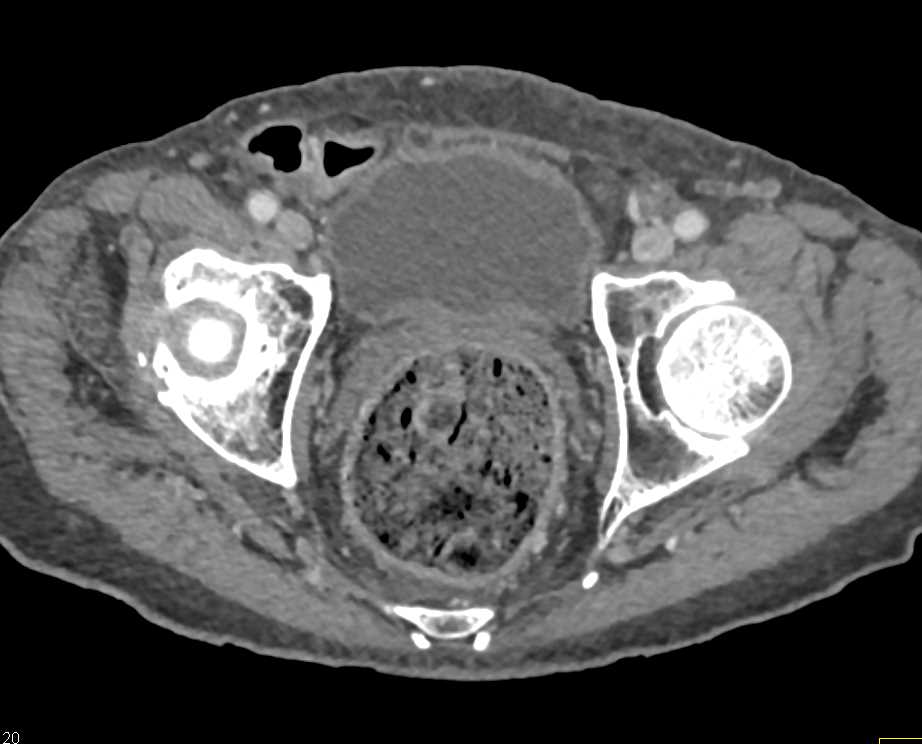 Stercoral Colitis - CTisus CT Scan