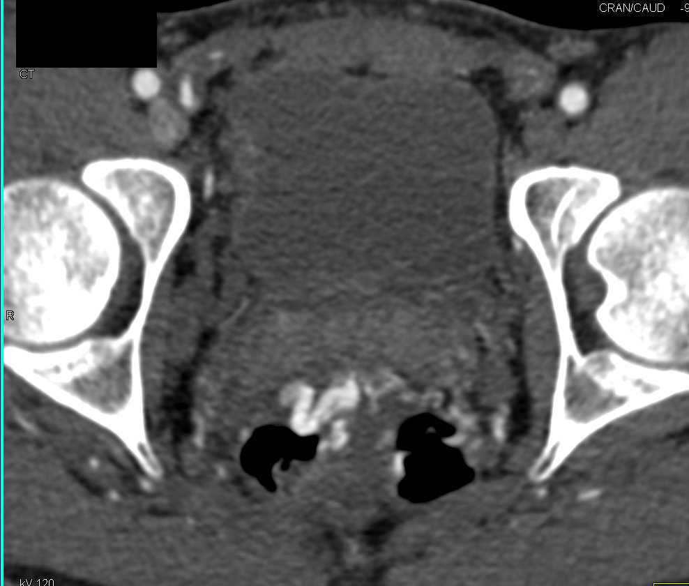 Rectal Varices - CTisus CT Scan