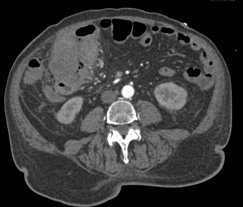 Perforated Colon Cancer - CTisus CT Scan