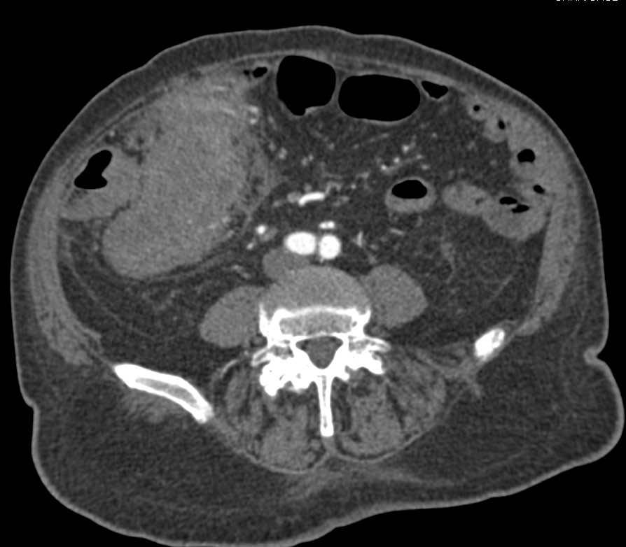 Perforated Colon Cancer - CTisus CT Scan