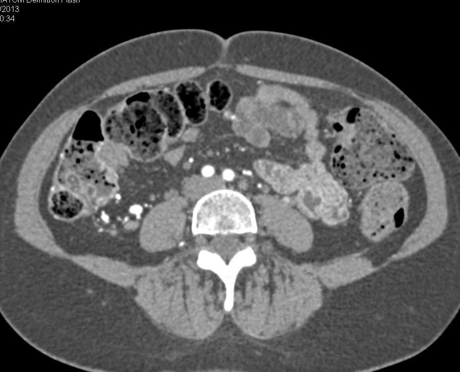 Acute Colitis Involves the Cecum and Right Colon with Prominent Vasa Recta - CTisus CT Scan