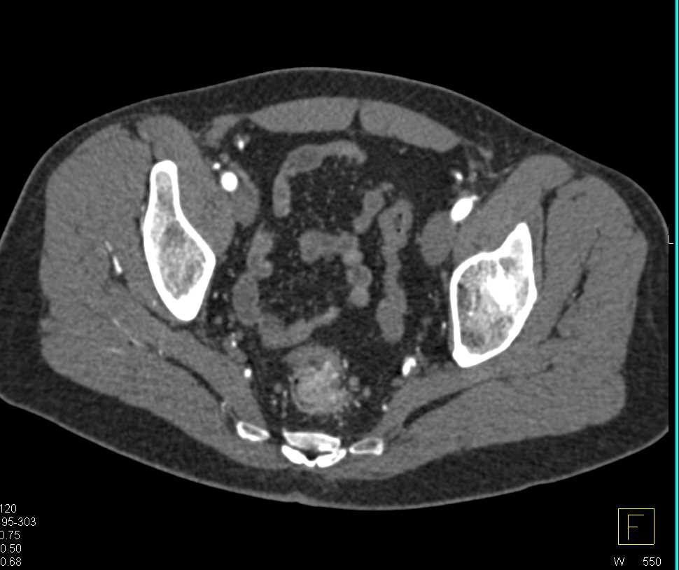 Colon Cancer with Vascularity - CTisus CT Scan