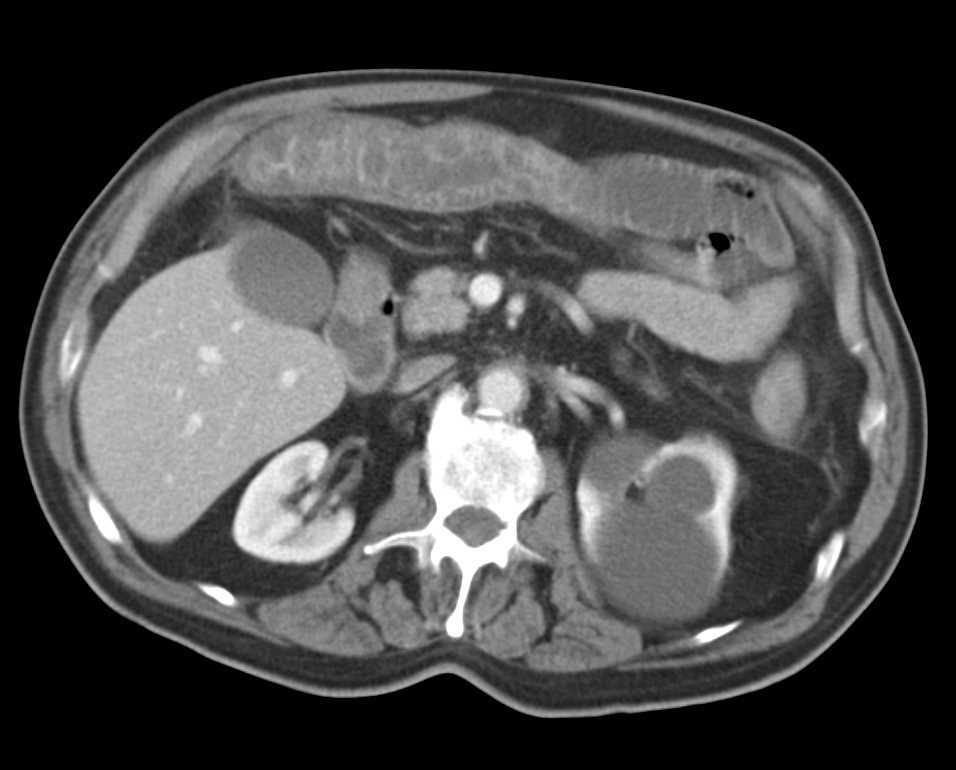 Colitis Transverse Colon - CTisus CT Scan