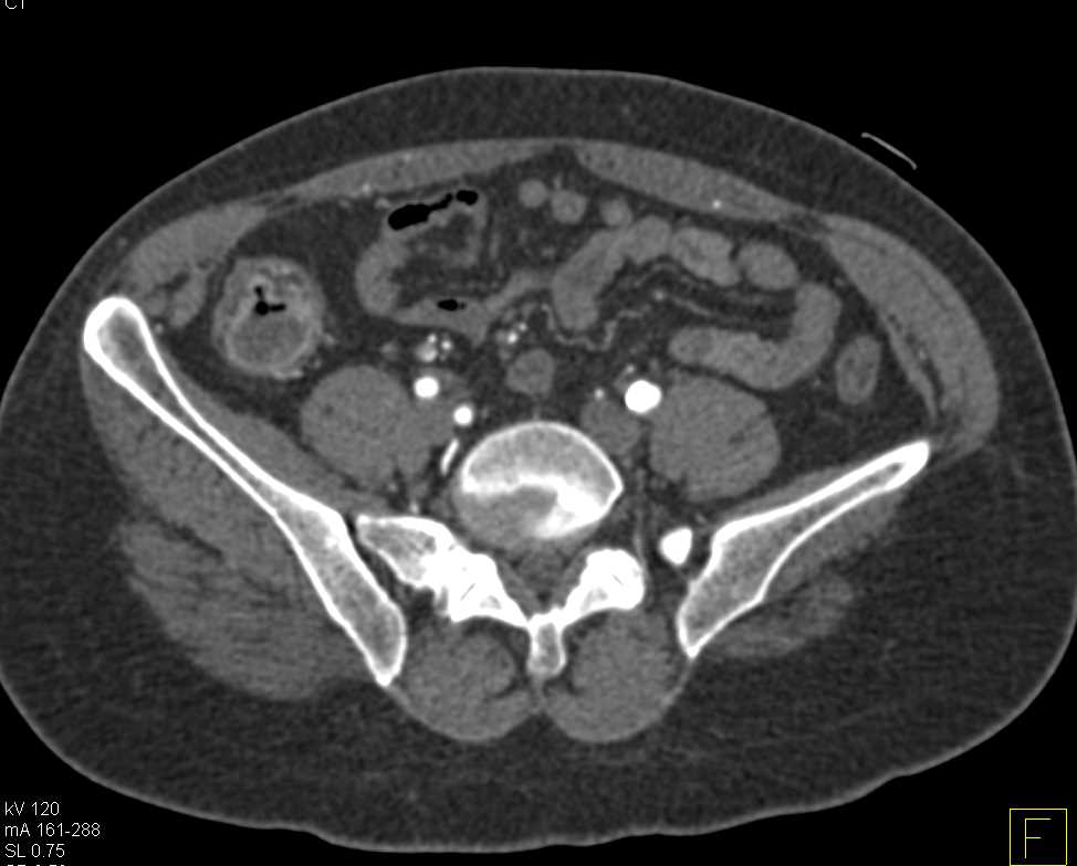 Inflammatory Bowel Disease Right Colon - CTisus CT Scan