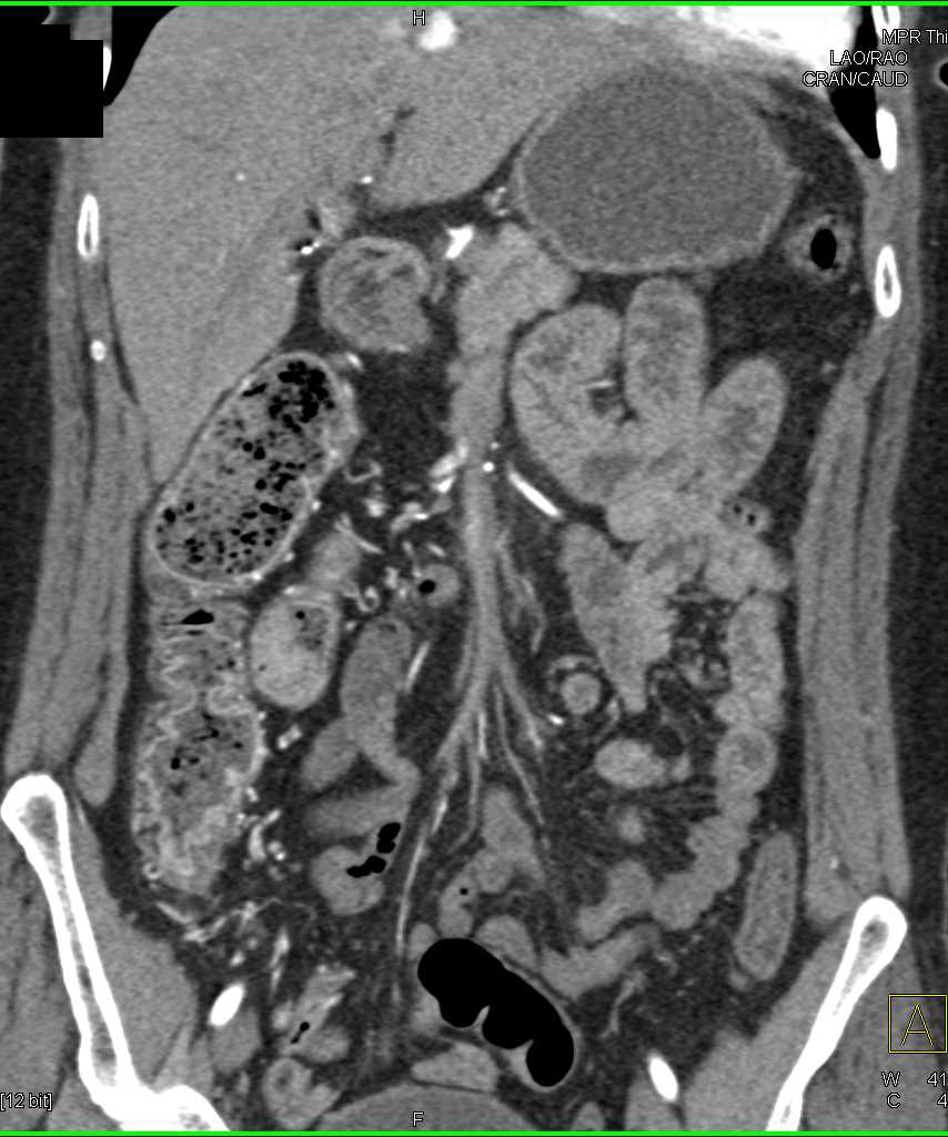 Inflammatory Bowel Right Colon with Prominent Vasa Recta - CTisus CT Scan