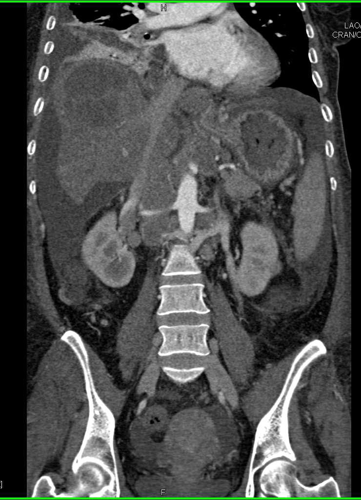 Colon Cancer with Adenopathy, Ascites and Liver Metastases - CTisus CT Scan