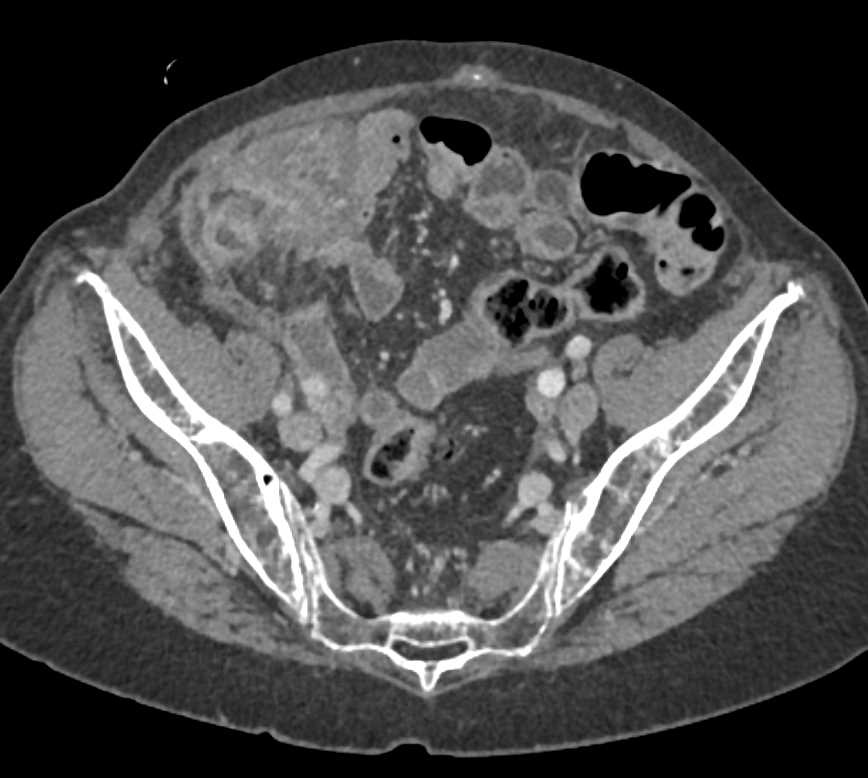 Cecal Carcinoma and Carcinomatosis - CTisus CT Scan