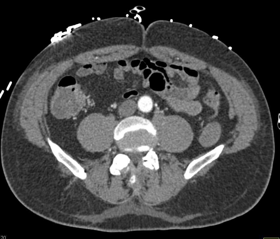 Active Bleed in Cecum on CT Angiography - CTisus CT Scan