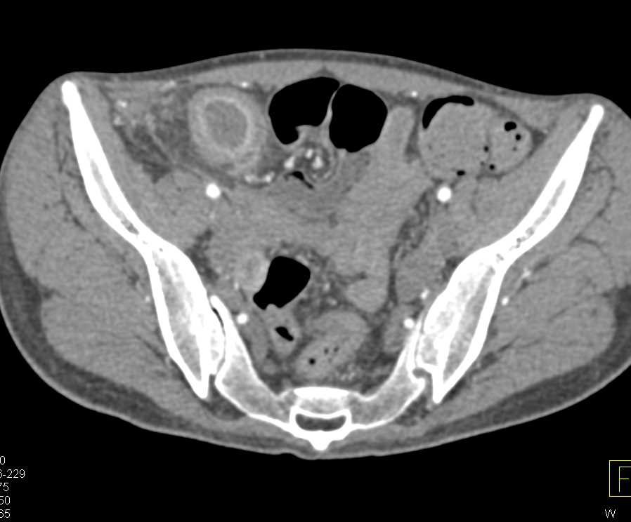 Crohn's Disease Involves the Terminal Ileum and Cecum - CTisus CT Scan