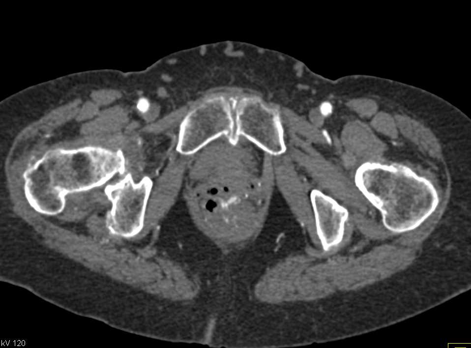 Active Rectal Bleeding - CTisus CT Scan