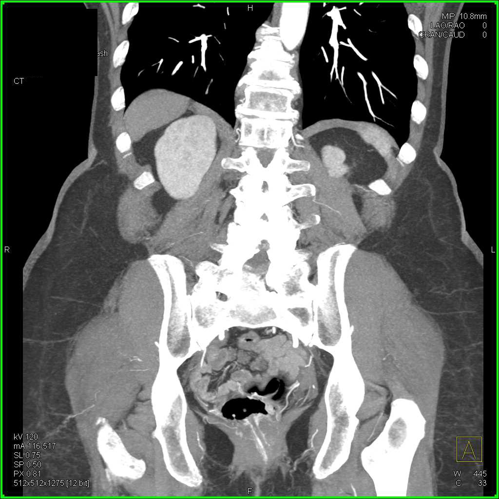 Active Rectal Bleeding - CTisus CT Scan