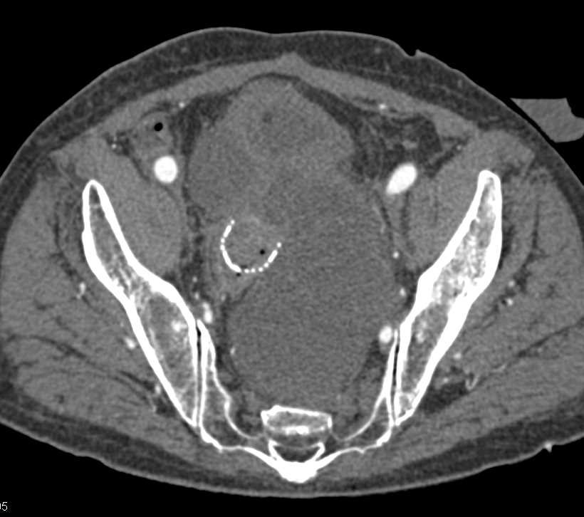 Stent in Rectum with Bulky Invasive Rectal Cancer - CTisus CT Scan