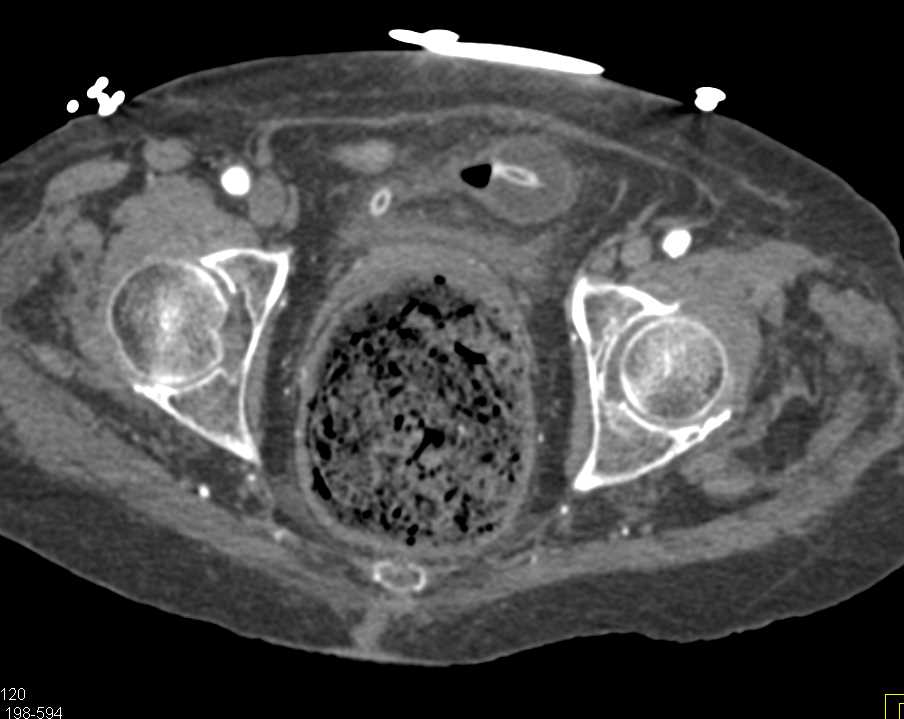 Stercoral Colitis with Distended Rectum - CTisus CT Scan