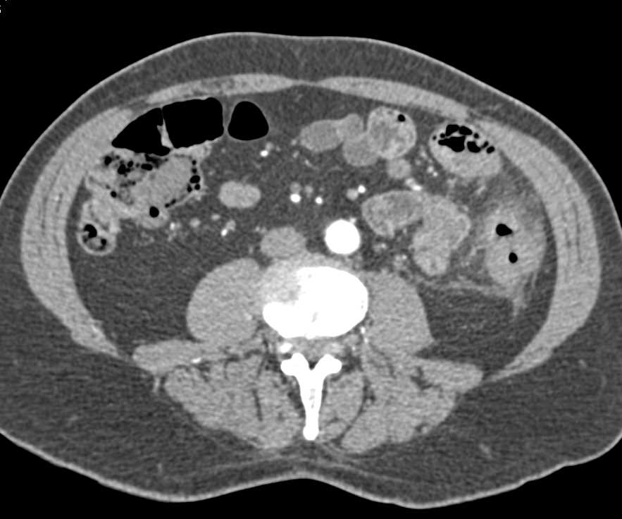 Diverticulitis Descending Colon Inflames Adjacent Jejunal Small Bowel Loops - CTisus CT Scan