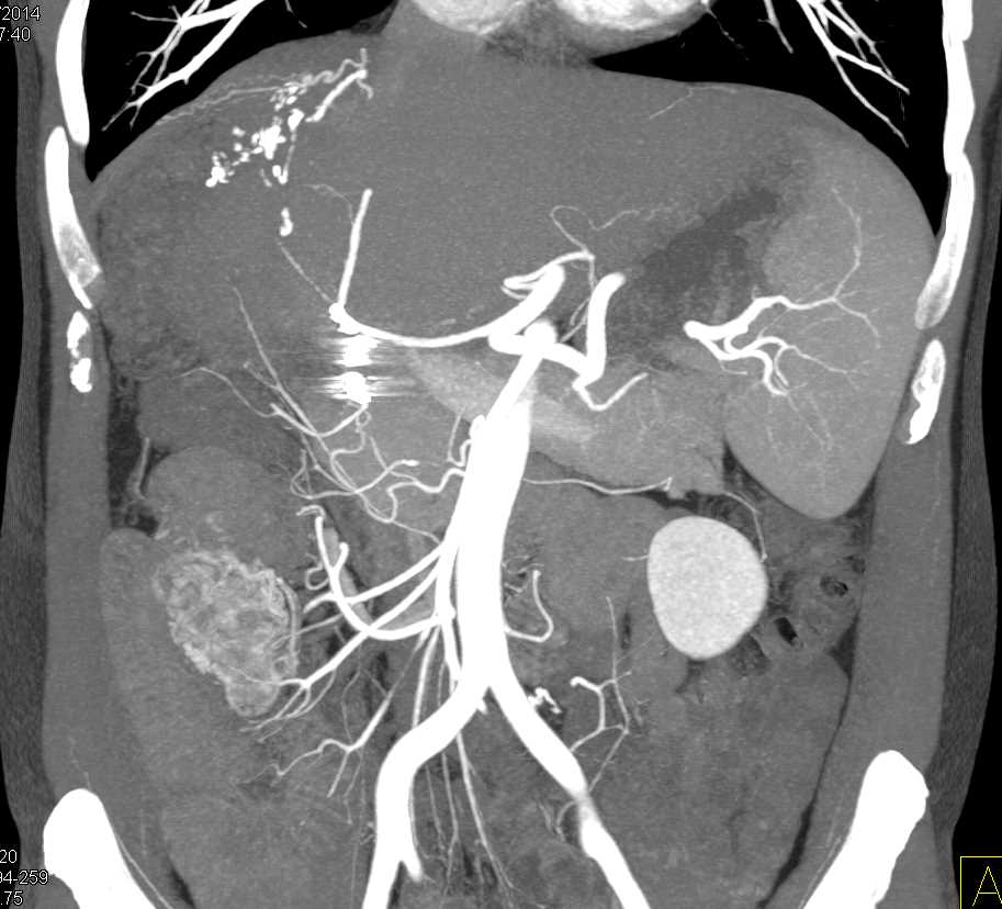 Resection Right Lobe Liver for Hepatocellular Carcinoma (Hepatoma) with Colitis in Cecum with Vascular Ectasia - CTisus CT Scan