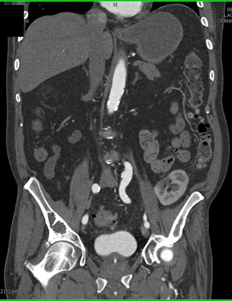 CT Cystogram with Colon Cancer Invading the Bladder - CTisus CT Scan