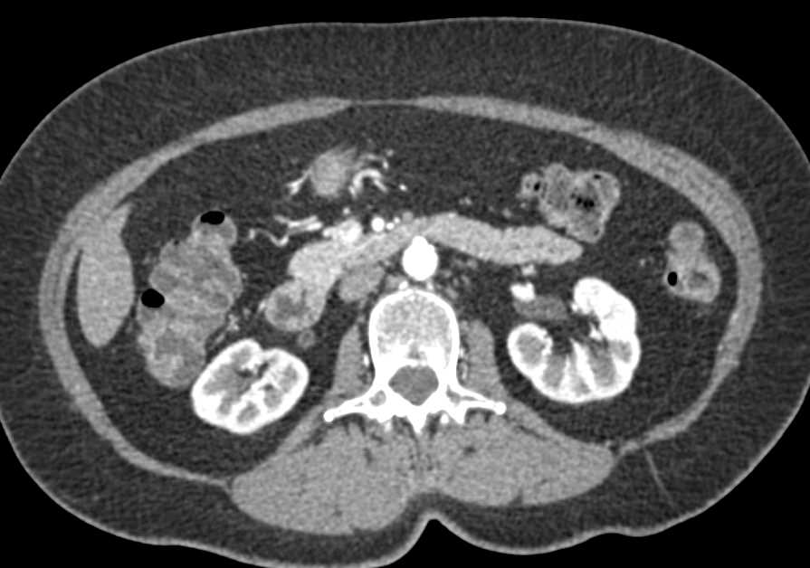 Incidental Cecal Carcinoma with Apple Core Like Lesion - CTisus CT Scan