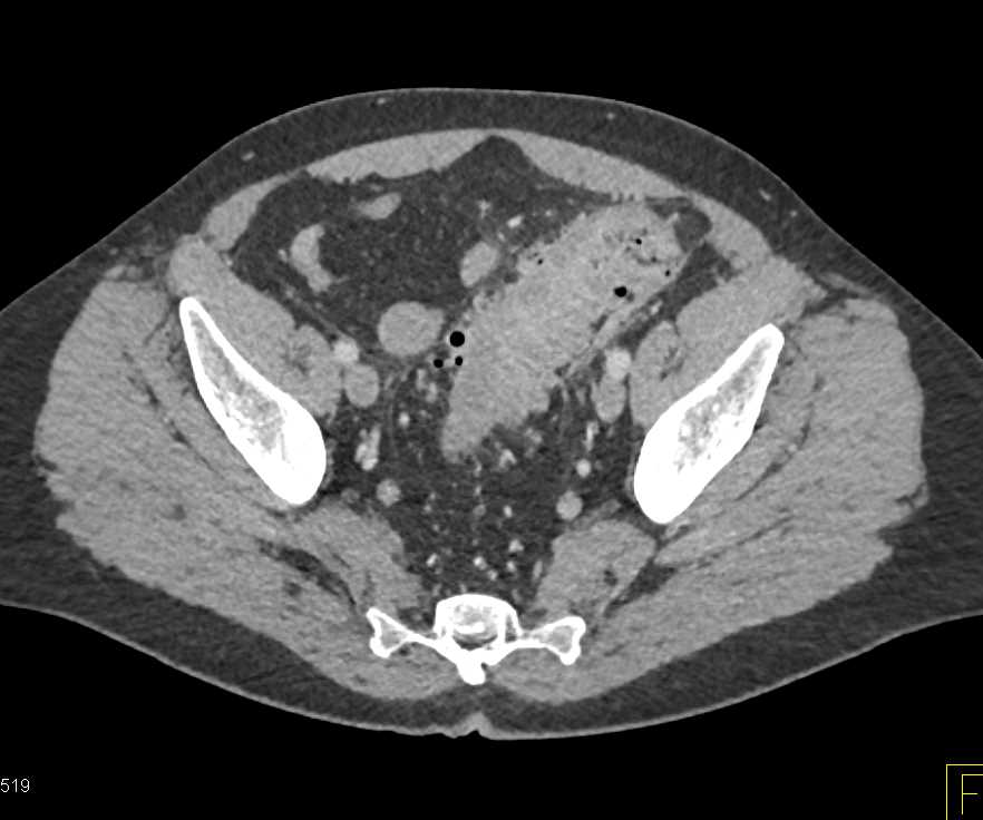 Diverticulitis with Fistulae to Dome of Bladder for Enterovesical Fistulae - CTisus CT Scan