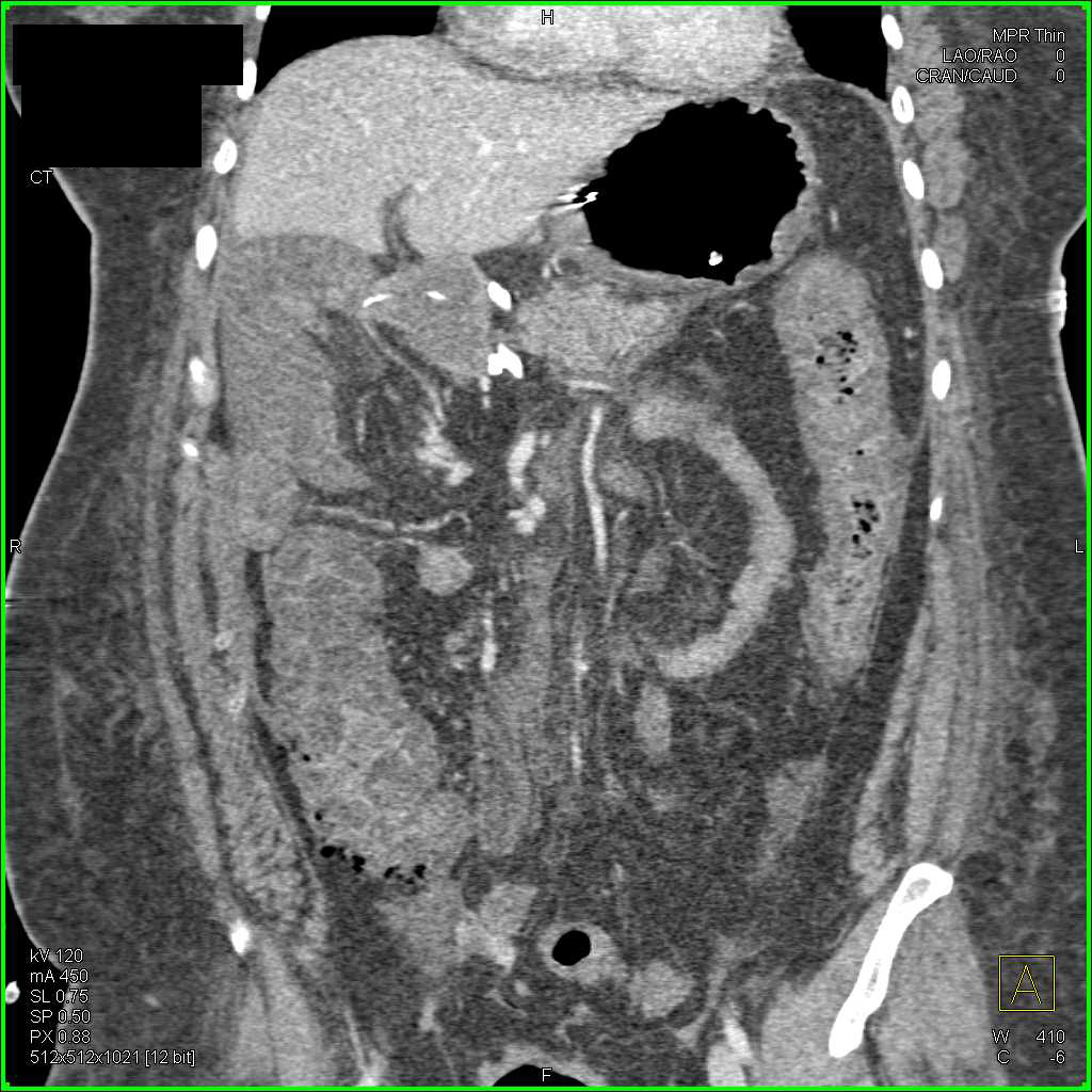 Pseudomembranous Colitis - CTisus CT Scan