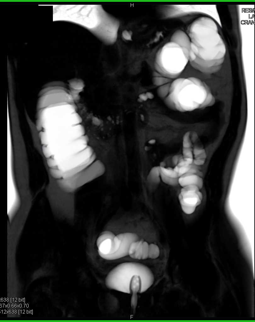 Polyp in Tortuous Descending Colon Which is on a Stalk - CTisus CT Scan
