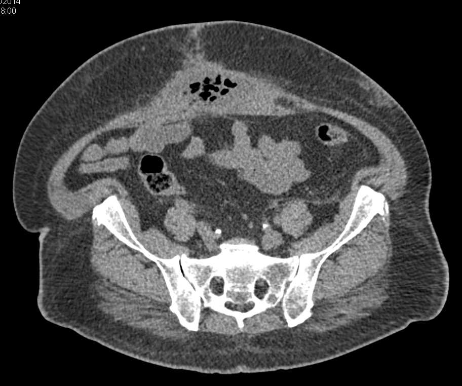 Abdominal Wall Abscess - CTisus CT Scan