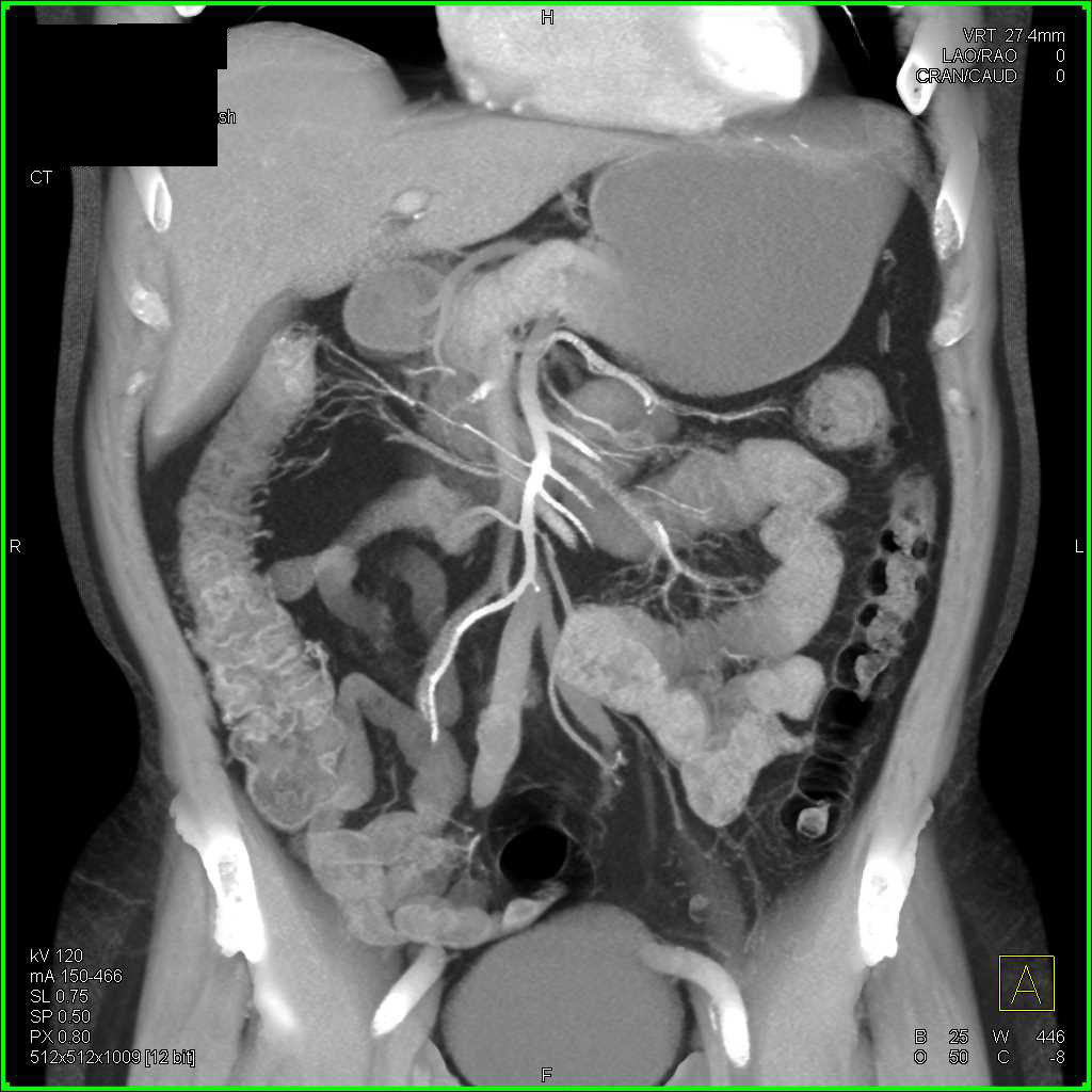 Ulcerative Colitis Best Seen in the Right Colon - CTisus CT Scan