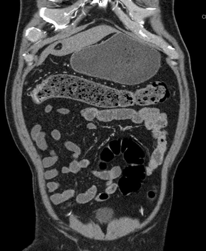Ulcerative Colitis Best Seen in the Right Colon and Transverse Colon - CTisus CT Scan