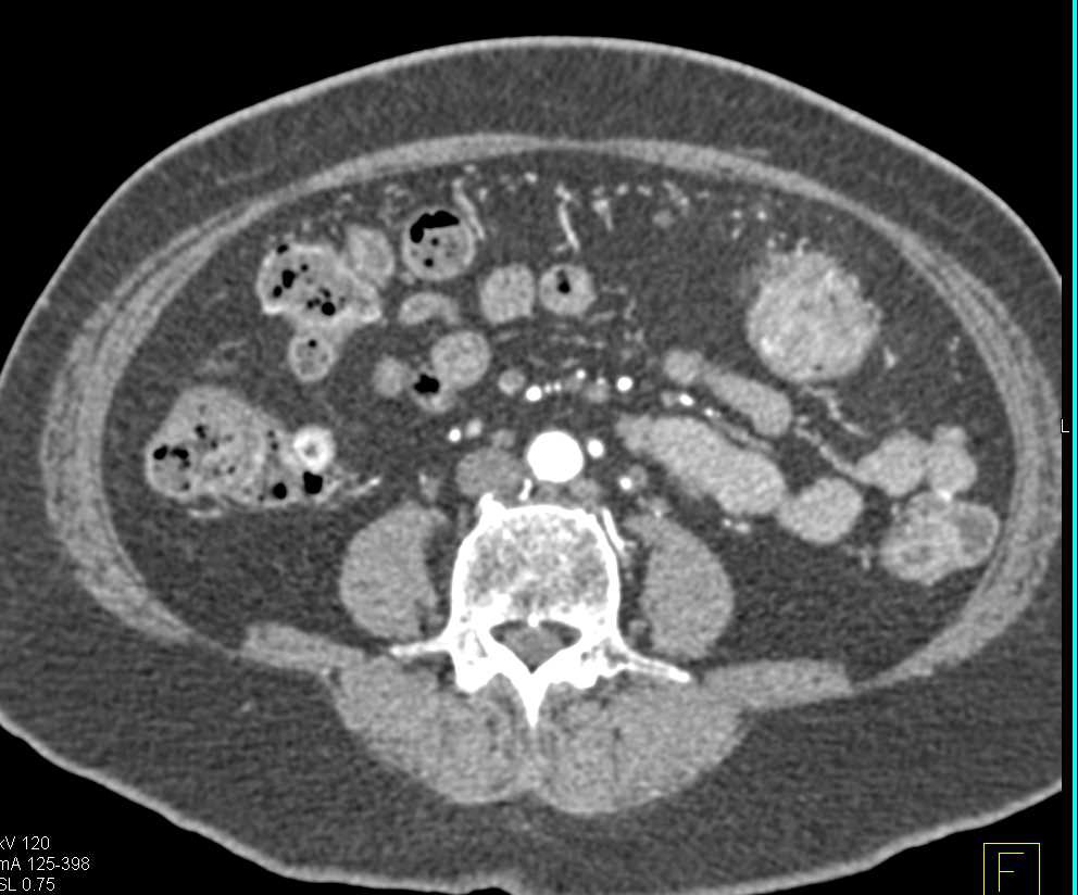 Transverse Colon Cancer in Patient with Long Standing Ulcerative Colitis - CTisus CT Scan