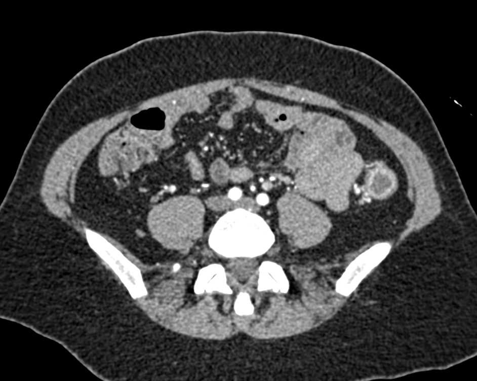 Acute Colitis Left Colon and Sigmoid Colon and Rectum with Prominent Vessels and Gastrointestinal (GI) Bleed - CTisus CT Scan