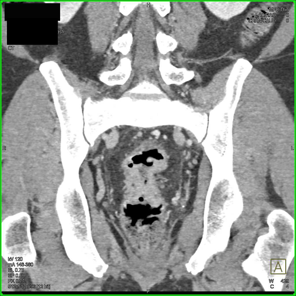 Ulcerating Rectal Cancer - CTisus CT Scan