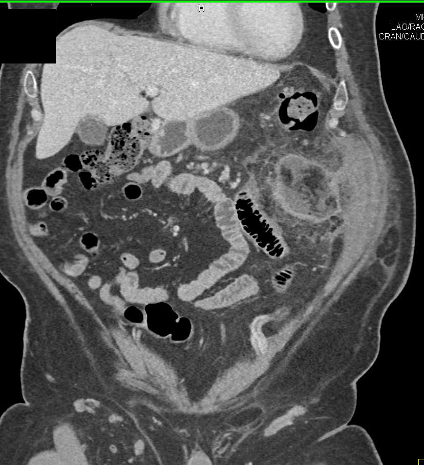 Omental Infarct in the Left Upper Quadrant - CTisus CT Scan