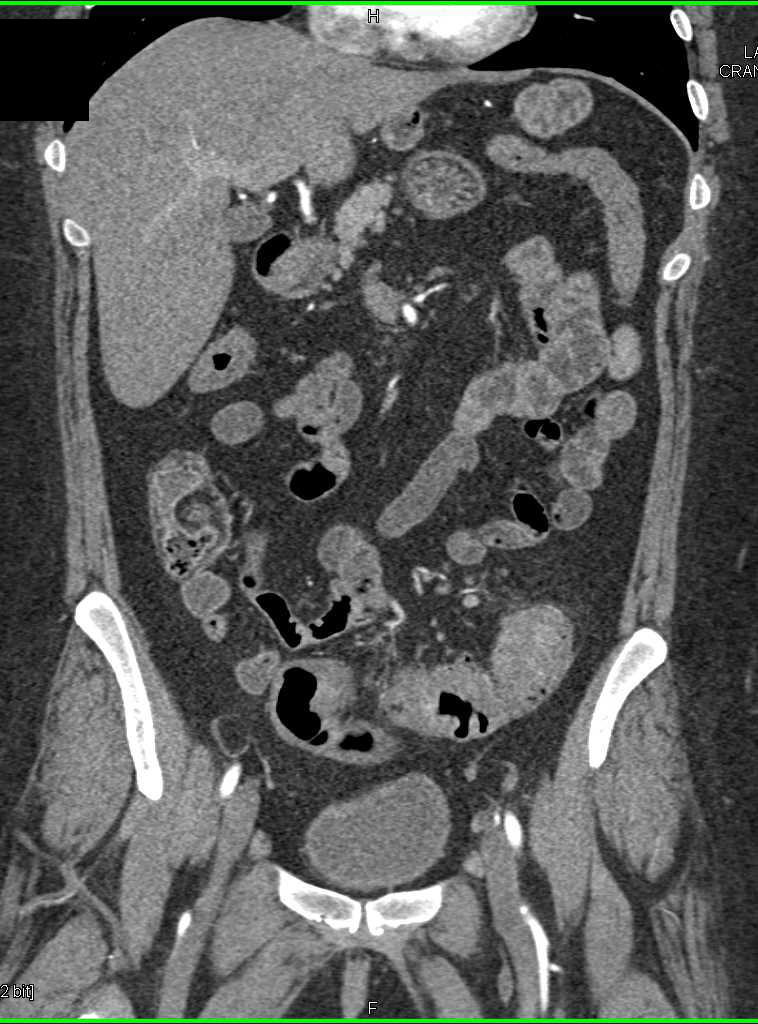 Diverticulitis Sigmoid Colon - CTisus CT Scan