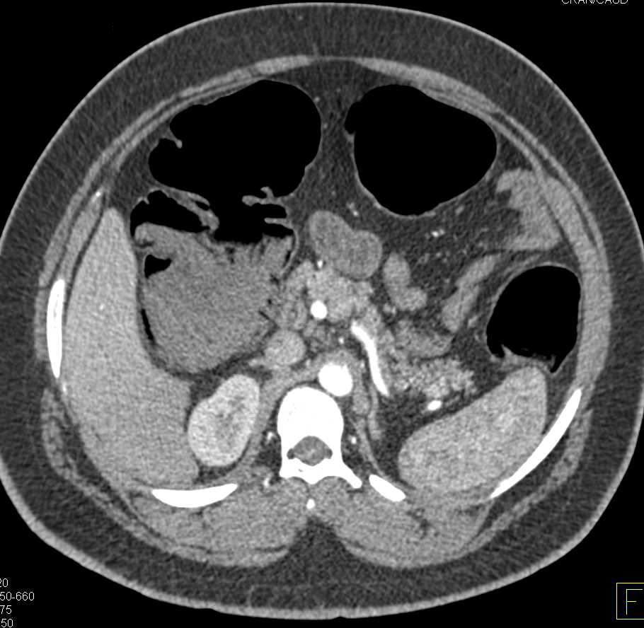 Pneumatosis Coli Best Seen on Lung Windows - CTisus CT Scan