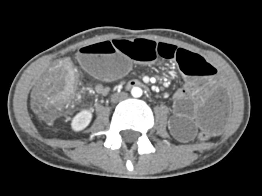 Acute Colitis Cecum with Inflammation and Some Strictures - CTisus CT Scan