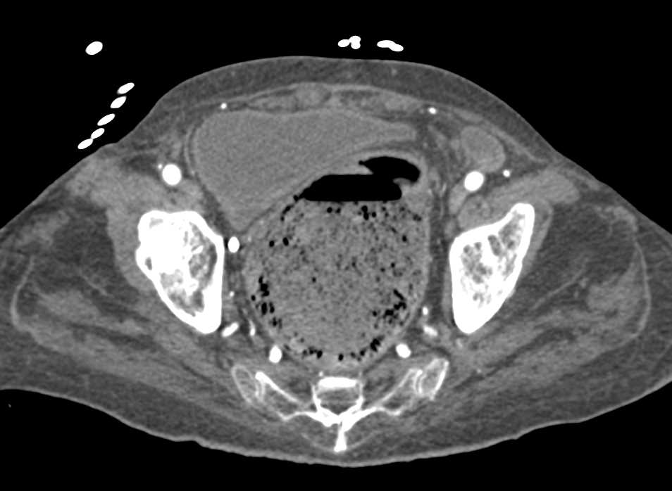 Stercoral Colitis - CTisus CT Scan