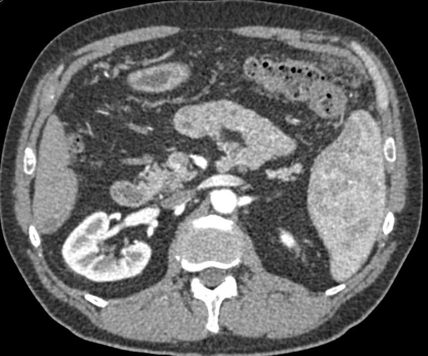 Carcinoma of the Splenic Flexure with Carcinomatosis - CTisus CT Scan
